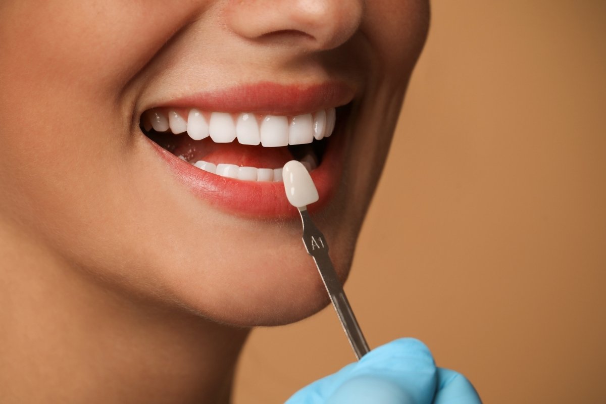 Зубные коронки GK Dental Clinic