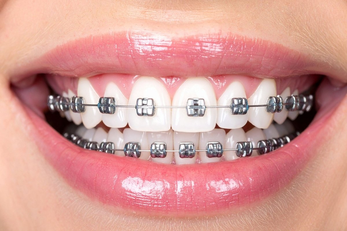 Зубные брекеты GK Dental Clinic