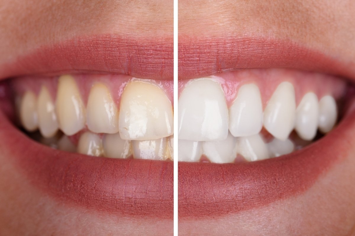 отбеливание зубов GK Dental Clinic